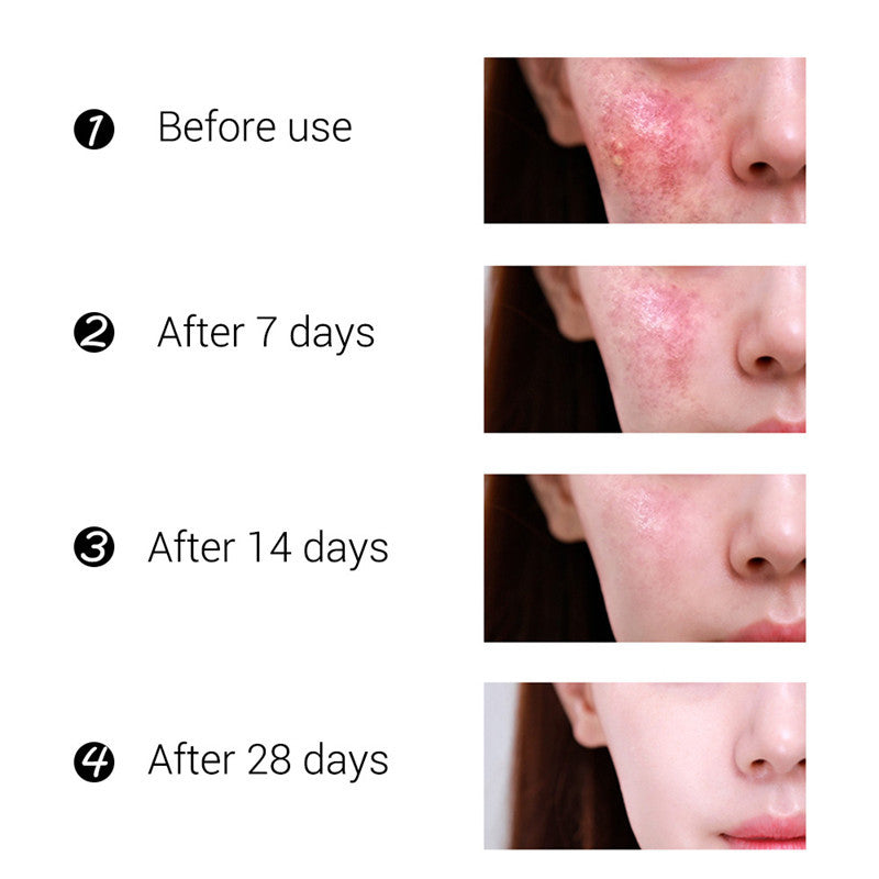 Acne Treatment Cream